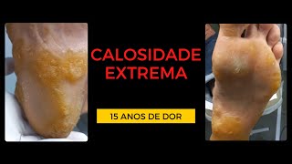 Impressionante Calosidade Extrema nos Pés  15 ANOS COM DOR PARTE 1 [upl. by Atirys]