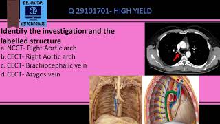 IDENTIFYING AZYGOS VEIN ON CT [upl. by Ahsenak]