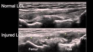 Sonographic Examination of Knee Ligaments [upl. by Golden]