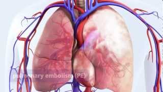 DVT can lead to pulmonary embolism PE [upl. by Onafets887]