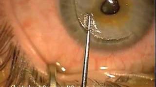 Surgical Removal of Epithelial Ingrowth after LASIK Surgery [upl. by Solorac]