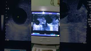 Ultrasound abdomenSimple hepatic cyst [upl. by Ylek]