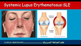 Lecture 12 Systemic lupus erythematosus SLE [upl. by Ahseenal242]