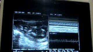 Miscarriage or spontaneous retained abortion 13 weeks [upl. by Gaither]