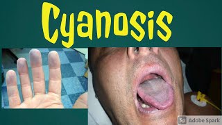 Cyanosis  Types and causes of cyanosis  central cyanosis and peripheral cyanosis in Hindi [upl. by Enytsirhc]