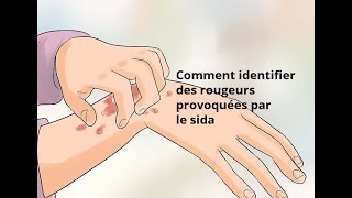 Comment identifier des rougeurs provoquées par le sida [upl. by Yesdnik]