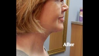 Learn about neck rejuvenation with platysmaplasty [upl. by Eob]