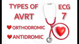 AVRT TYPES ORTHODROMIC AND ANTIDROMIC [upl. by Ecirtram598]