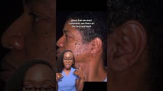 Causes of Brown Bumps on the Face Dermatosis Papulosa Nigra DPN and Treatment [upl. by Ezri]