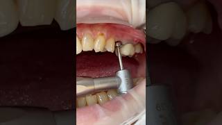 임플란트 세멘리스보철 dental dentist implantdentist cementless [upl. by Nauqet]