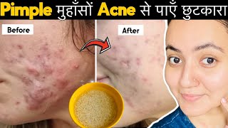 सिर्फ 7 दिनों में PIMPLESमुंहासे दागधब्बे Acne Marks को जड़ से खत्म करेंपाए बेदाग़ Glowing Skin💕 [upl. by Leuamme]