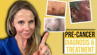 Actinic keratosis treatment guide from a Dermatologist [upl. by Aynnek]