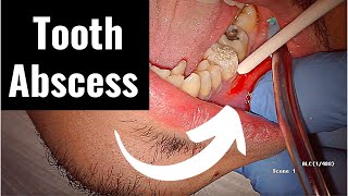 Incision and Drainage of Tooth Abscess Draining Pus [upl. by Inig]