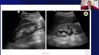 Hydronephrosis vs Normal Kidney [upl. by As]