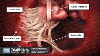 Diagnostic Laparoscopy with Lysis of Adhesions [upl. by Perot]