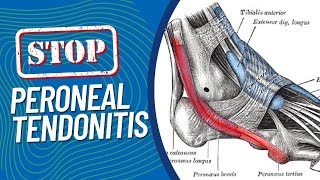 ResearchBacked Treatments for Peroneal Tendonitis Pain on the Outside of Your Foot When Running [upl. by Keel]