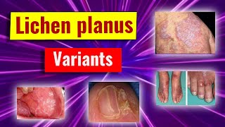 Clinical variants of lichen planus [upl. by Legra]