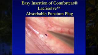 Inserting the Comfortear® Lacrisolve® 180 Absorbable Punctum Plug [upl. by Llenhoj]