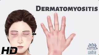 Dermatomyositis Everything You Need To Know [upl. by Yekcir536]