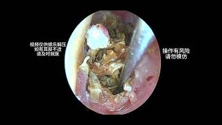 Cleaning a large amount of earwax that severely blocks the ear canal earwaxremoval earwax cleaning [upl. by Epilef]