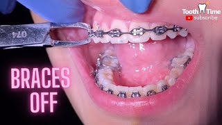 Braces off  What happens when you get your braces off  Tooth Time Family Dentistry New Braunfels [upl. by Aenej]