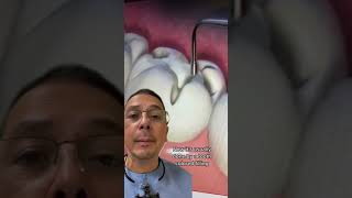 How Does a Dentist Fill a Cavity  View Mobile Dental [upl. by Gnous456]