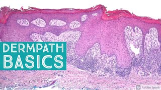 Basic Dermpath Cases  Explained by a Dermatopathologist [upl. by Aiden87]