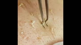 The Best Blackhead Tweezers [upl. by Kcirddehs]