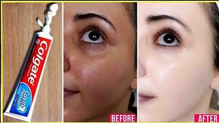 Apply Toothpaste on Your Skin and See Magical Result within 1 Hour  Amazing Toothpaste Beauty Hacks [upl. by Aiam666]