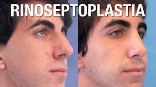 Rinoplastia Masculina  Antes y Después  Clínicas Diego de León [upl. by Catie226]