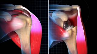 Biomechanical Summary of Reverse Shoulder Arthroplasty [upl. by Lizette]