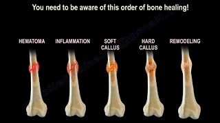 How Does Broken Bone Heal [upl. by Eniamrahc]