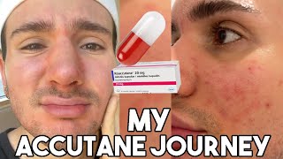 STARTING ACCUTANE JOURNEY The best skincare products to use while on accutane [upl. by Saint793]