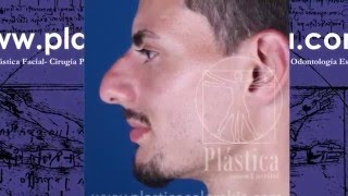 Caso REAL  RINOPLASTIA nariz grande masculina [upl. by Aigneis]