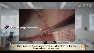 ABS PLUG An effective treatment for dry eyes Punctal Plugs [upl. by Avruch]