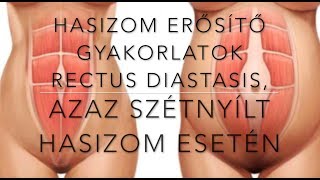 Hasizom erősítése Rectus Diastasis azaz szétnyílt hasizom esetén [upl. by Martz]