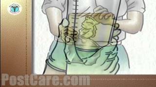 Discharge Emptying a Urinary Drainage Bag MiniFree Patient Education Medical Video [upl. by Naellij]