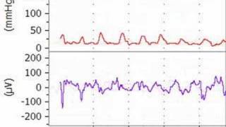 Lipid Reversal of Bupivacaine Toxicity [upl. by Elleynod]