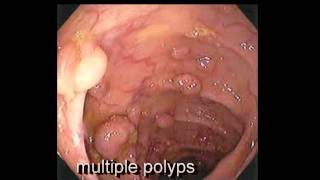 Colonoscopy FollowUp of Colon Polyp  Los Angeles Colonoscopy [upl. by Atsilac]