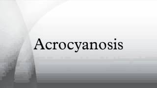 Acrocyanosis [upl. by Annert695]