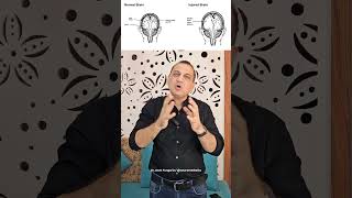 सिर में यह गैप कैसे आ गया Post Craniectomy Bone Defect NeuroMedTalks01 neurosurgeon brain [upl. by Ihp]