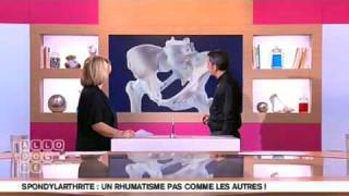 Présentation de la Spondylarthrite Ankylosante [upl. by Ramraj730]