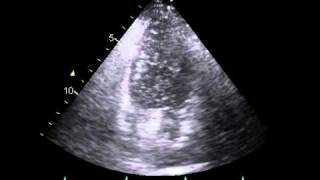 Patent formamen ovale PFO with severe rightleft shunt [upl. by Brozak]