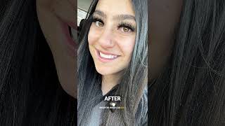 6 Months with Veneers My Smile Transformation Journey 🌟  Veneers Before amp After  Teeth Whitening [upl. by Frasco]