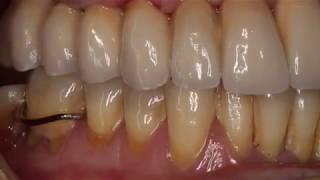 Implantes Naturactis LyraETK Con Carga Inmediata  Rehabilitación Superior Con Coronas De Zirconio [upl. by Michaella]