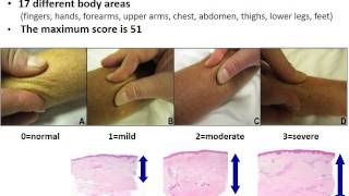 Webinar Diagnosis and Early Management of Scleroderma with Dr Francisco Boin 2015 [upl. by Eleonore]