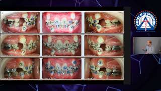 Monday Tip Importance of Cephalometric Analysis in Extraction Cases [upl. by Avert697]