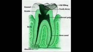 Periodontitis apical aguda [upl. by Ainahtan]