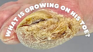 What is GROWING on his TOE [upl. by Ahsikel]