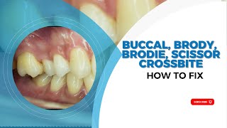 Buccal Brody Brodie Scissor Crossbite and How to Fix [upl. by Shellie]